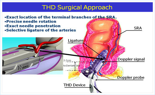 THD surgical approach