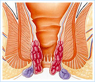 prolapsed internal external haemorrhoids