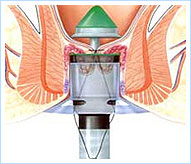 PPH set or Longo Haemorrhoidectomy Stapling Device