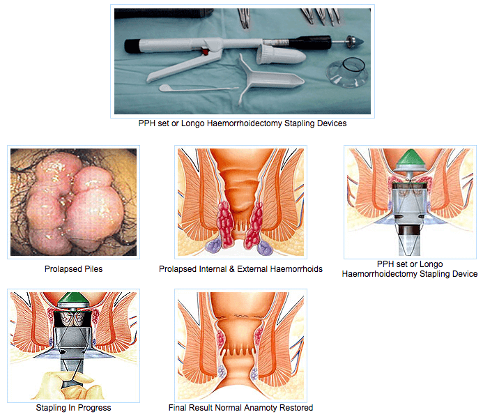 piles surgery singapore