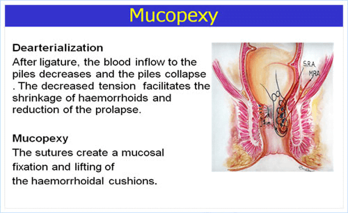 Mucopexy